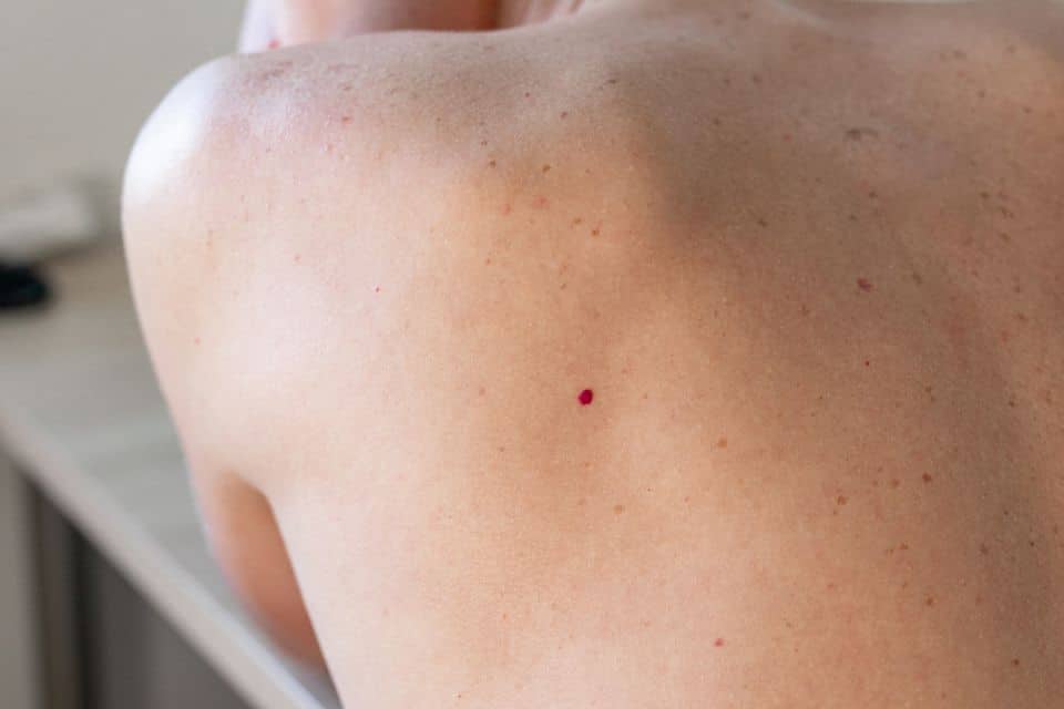 Puntos de sangre en la piel: Qué son y cómo quitarlos