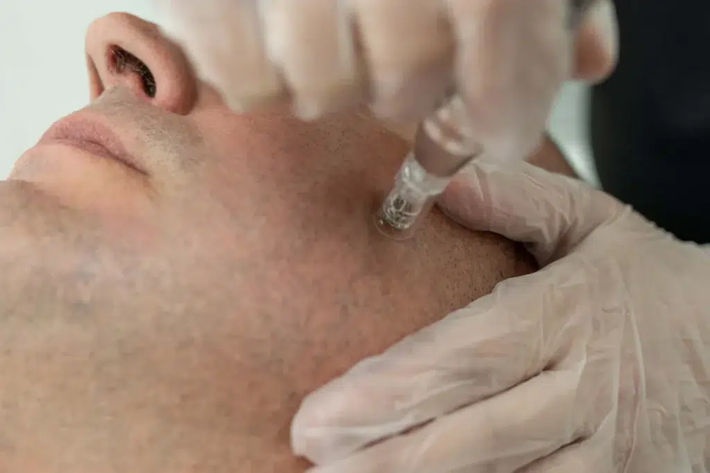 paciente haciéndose el tratamiento de dermapen facial
